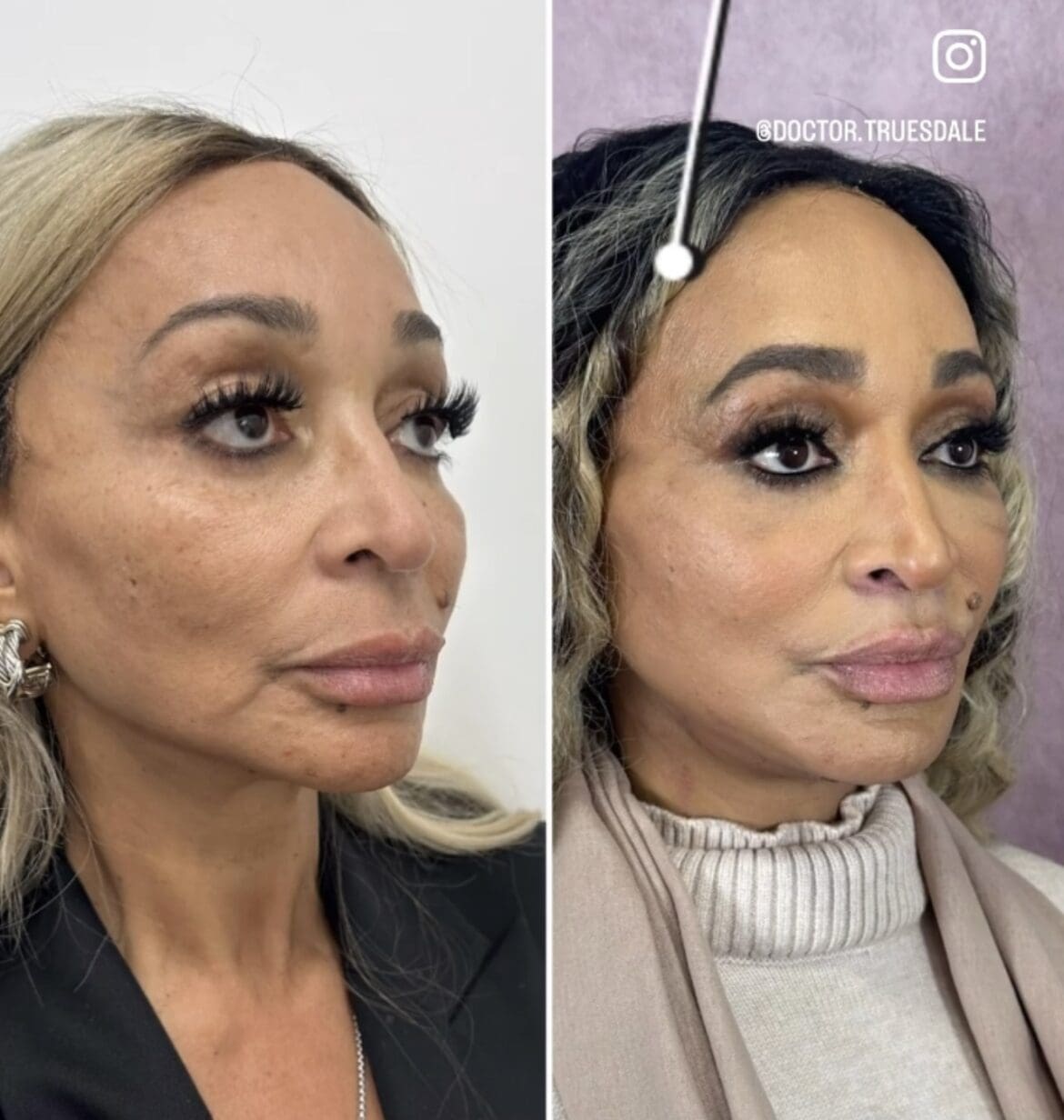 photos-rhop-s-karen-huger-undergoes-facelift-see-her-before-after