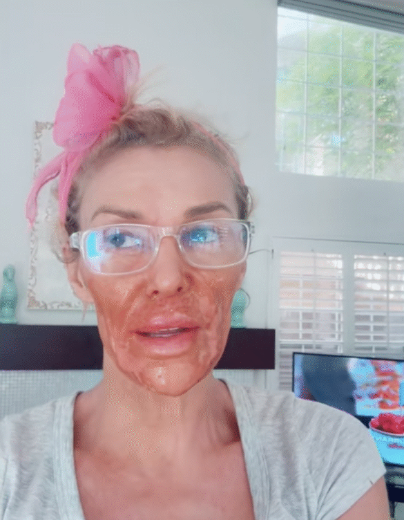 Brandi Glanville Dubs Her Facial Parasite "Caroline" After Housewives Feud