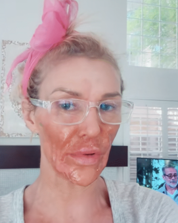 Brandi Glanville Dubs Her Facial Parasite "Caroline" After Housewives Feud