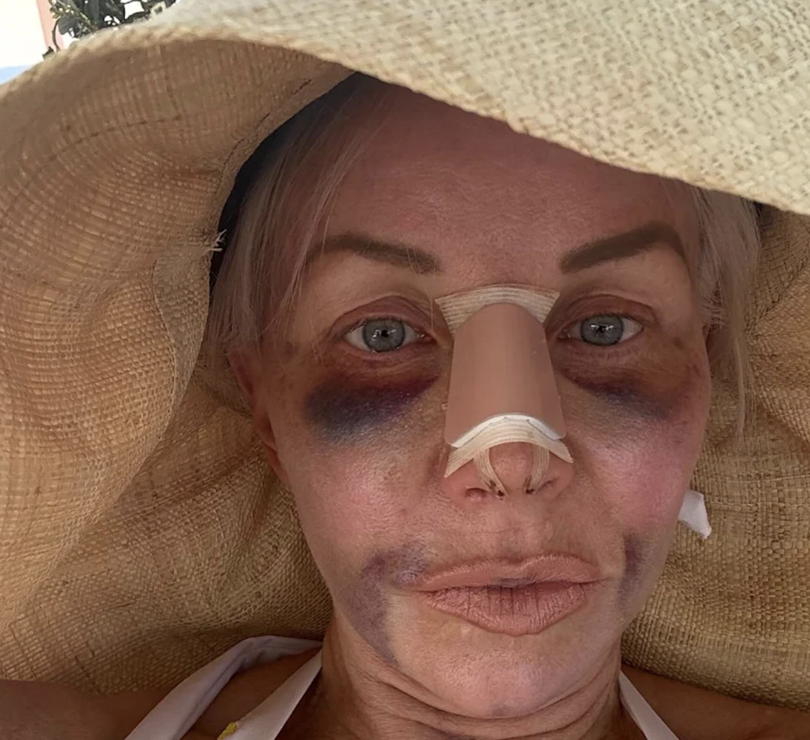Margaret Josephs Shows Off Bruised Post-Op Photos After Getting a Nose Job