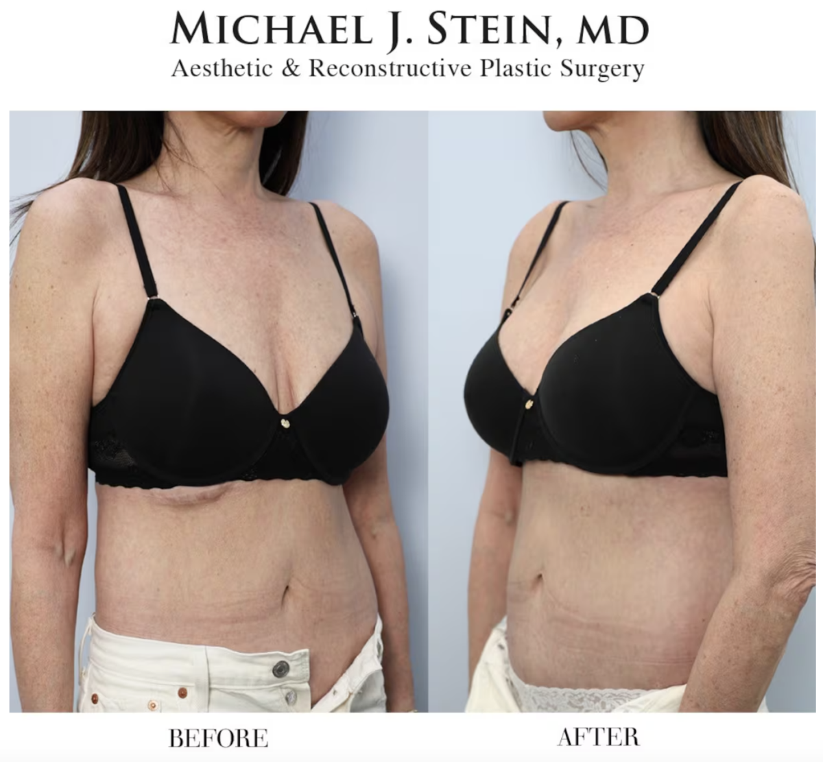 Jennifer Fessler Shares Before-and-After Photos After Undergoing Five Boob Jobs