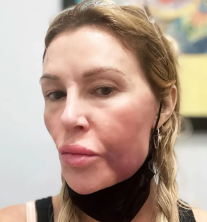 Brandi Glanville Reveals She Has A “Benign Tumor” In Her Face After Saying Her Facial “Parasite” Returned
